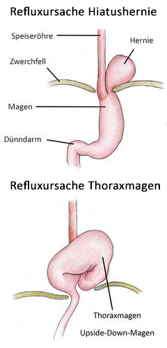 Reflux: Ursache Hiatushernie und Thoraxmagen